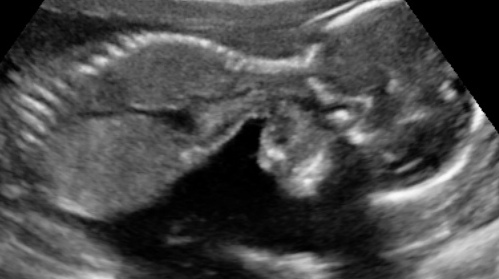 Lexi_19weekultrasound